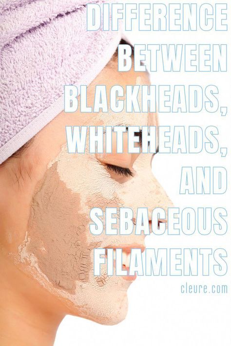 There are multiple types of acne and skin blemishes, each with different causes, effects, and solutions. Determining what exactly is causing the bumps on your skin will make treating them much easier and more effective.  A common cause of acne is clogged pores which typically results in blackheads and whiteheads. It’s Skin Care For Whiteheads, How To Get Rid Of White Heads On Chin, White Heads Removal Remedies, Whiteheads Removal Remedies, What Causes Blackheads, Neck Pimples, Whiteheads Removal, Blackheads On Cheeks, Cause Of Acne