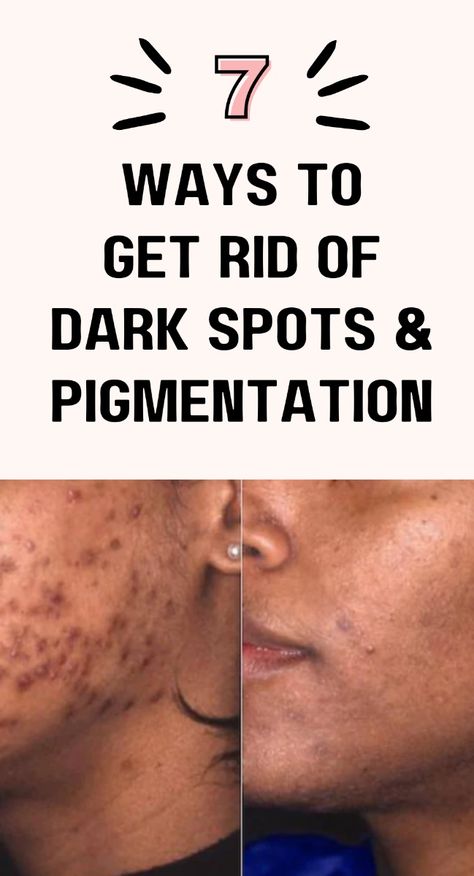 In this post, I discuss how to clear hyperpigmentation dark spots (especially dark spots on face due to acne). Learn my oily skin care routine (black skin care). Hyperpigmenation black skin products. Learn to get rid of hyperpigmentation FAST! Black Acne Skin Care, Rid Of Dark Spots On Face, Dark Skin Spots How To Get Rid, Reduce Dark Spots On Face, Acne And Dark Spots Skin Care, Getting Rid Of Dark Spots On Face, Black Spots On Face Remove Fast, How To Get Rid Of Hyperpigmentation Fast, How To Get Rid Of Dark Spots