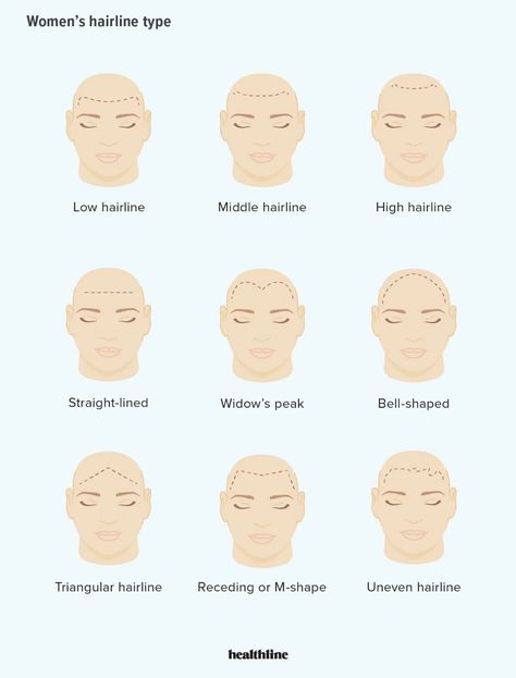 Hairline Types For Men and Women, Plus How to Change Your Type Hairline Types, Male Hairline, Men Hairline, Uneven Hairline, Androgenic Alopecia, Traction Alopecia, Stop Hair Breakage, Female Pattern Baldness, Androgenetic Alopecia