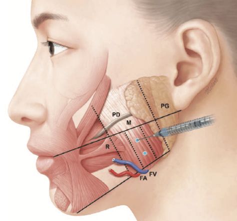 Masseter Muscle Botox injections – the new clinical protocol Fat Anatomy, Botox Injection Sites, Medical Skincare, Facial Injections, Botox Before And After, Aesthetic Dermatology, Facial Anatomy, Botox Cosmetic, Botox Face