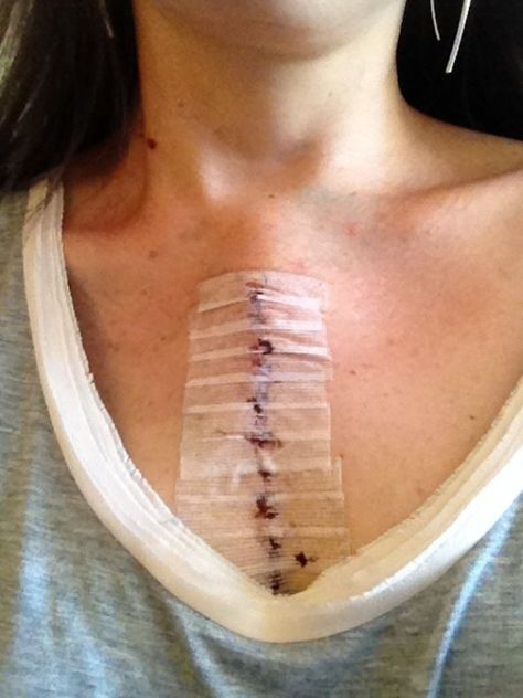 Learning to love your open heart surgery scar | Heart Sisters Heart Surgery Recovery, Surgery Prep, Heart Sisters, Cassie Lang, Tattoo Over Scar, Character Studies, Heart Valves, Open Heart Surgery, Congenital Heart Defect