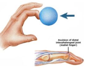 Did a ball or other object hit the end of your finger? Did you smack the end of your finger against something hard, or crush your fingertip in a door or drawer? If so, you may have Mallet Finger. Mallet Finger also called “baseball finger,” is when the end of your finger droops in a bent position and won’t straighten by itself. You can push your finger into a straight position but it won’t stay straight without support. What should you do about your mallet finger? Mallet Finger, Nail Falling Off, Finger Injury, Broken Finger, Finger Exercises, Ligaments And Tendons, Leather Work Gloves, Trigger Finger, Hand Therapy