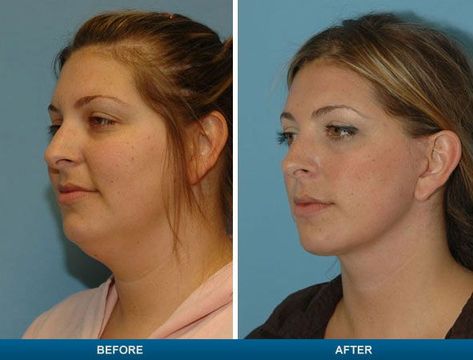 double chin face fat Double Chin Surgery, Neck Lift Surgery, Fitness Before And After Pictures, Reduce Face Fat, Double Chin Removal, Double Chin Exercises, Chin Exercises, Face Lift Surgery, Double Menton