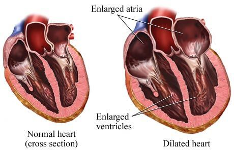 Enlarged Heart Symptoms, Enlarged Heart, Heart Valves, Normal Heart, Medical Procedures, Heart Healthy Diet, Gene Therapy, Anatomy Physiology, Naturopathy