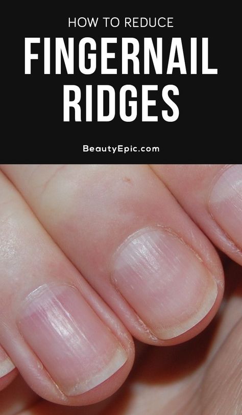 Find Out Whether Those Ridges On Your Fingernails Are Harmful Or Not Fingernail Ridges, Fingernail Health, Nail Remedies, Nail Ridges, Nail Fungus Remedy, Nail Infection, Fungal Nail, Tongue Health, Nail Care Tips