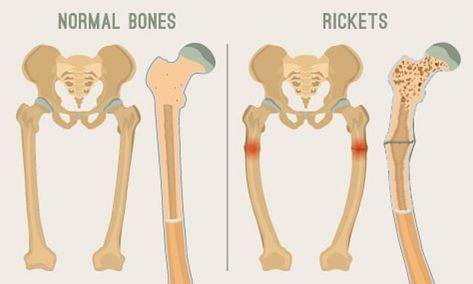 UK Children at risk of rickets epidemic as they spend less time outside and more watching screens | Daily Mail Online Too Much Vitamin D, Steve Jones, Vitamin D Supplement, Bone Diseases, Vitamin D Deficiency, Baby Legs, Natural Pain Relief, Chest Workouts, Healthy Bones