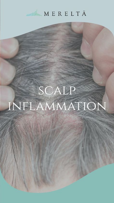 Scalp Inflammation Dry Scalp Remedy, Inflammation Remedies, Dandruff Remedy, Clean Scalp, Dandruff Shampoo, Mild Shampoo, Dry Scalp, Dandruff, Makeup Tips