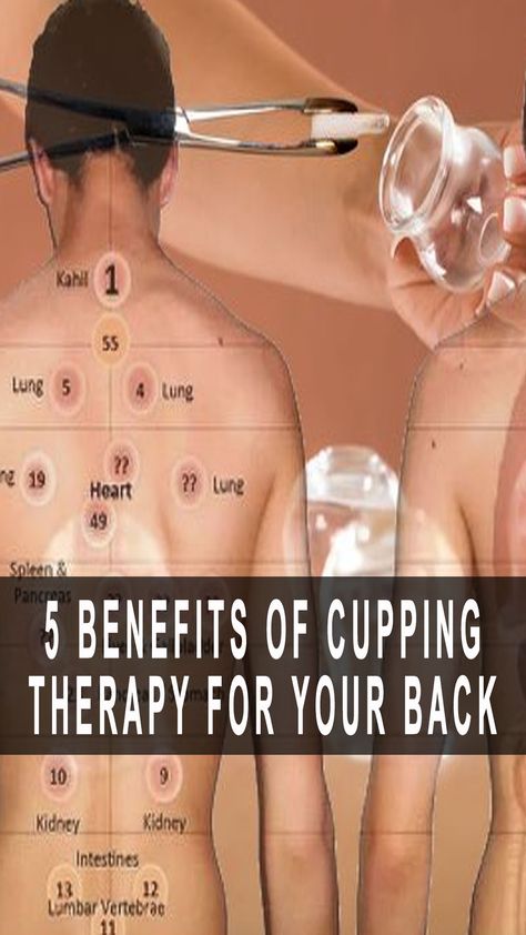 5 Benefits Of Cupping Therapy For Your Back Cupping Points Chart, Dry Cupping Therapy Chart, Cupping Placement Chart, Cupping Therapy Chart, What Is Cupping Therapy, Cupping Points, Benefits Of Cupping, Fire Cupping, Stomach Cramps