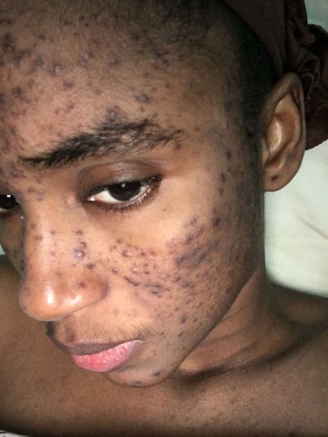 A MODEL claims that her career is ruined thanks to a Swiss skincare line which she alleges scarred her face after it caused severe acne. Mariama Diallo – who won Miss Guinea, Miss West Africa and was a contestant in the Miss World pageant – claims she started using the Makari De Suisse products in […] Ruins, Mariama Diallo Model, Ugly Dress, Mariama Diallo, Ugly Dresses, Bad Acne, Severe Acne, Breast Reduction, Remove Acne