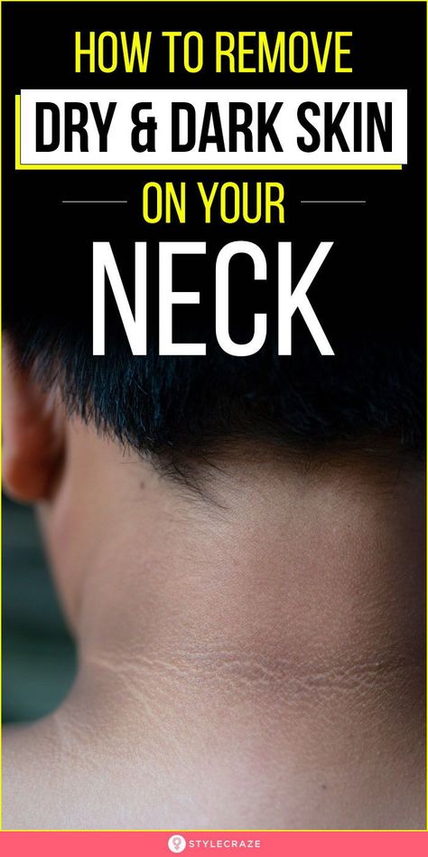 Diy Dark Spot Remover Under Arms, Neck Scrub Dark, How To Remove Dark Spots On Neck, How To Whiten Neck, Neck Discoloration Remedies, How To Remove Dark Neck Remedies, Clean Neck Skin, How To Clean Dark Neck, Hyperpigmentation On Neck