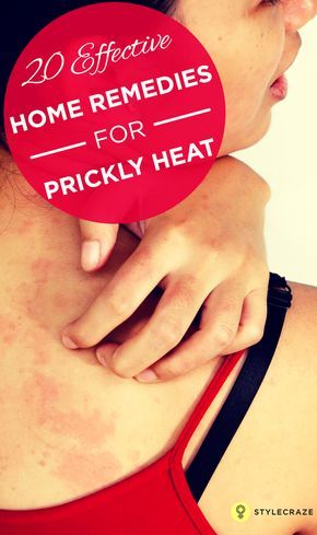 Heat Rash On Face, Heat Bumps, Heat Rash Remedy, Burn Remedies, Prickly Heat Rash, Home Remedies For Rashes, Home Remedies For Face, Ankle Strength, Medical Remedies