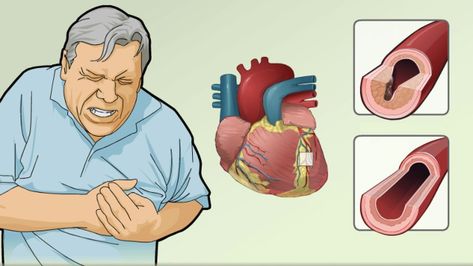 Coronary Artery Disease and Angina Chest Discomfort, Generic Medicines, Coronary Artery, Angina Pectoris, Clogged Arteries, Coronary Arteries, Brain Exercise, Heart Problems, Chest Pain