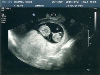 Identical Twins Ultrasound, Twin Ultrasound, Twins Ultrasound, Having Twins, First Ultrasound, Baby Ultrasound, Fraternal Twins, Ultrasound Pictures, Usa Baby