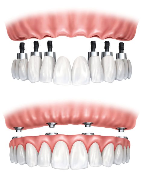 Dental Bridge Cost, Dental Images, Dental Implant Procedure, Denture Implants, Best Dental Implants, Dental Implant Surgery, Dental Implants Cost, Implant Dentistry, Teeth Implants