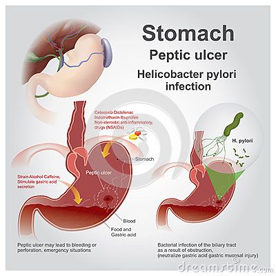 Eptic ulcer disease, also known as a peptic ulcer or stomach ulcer, is a break in the lining of the stomach, first part of the small intestine, or occasionally the lower esophagus.An ulcer in the stomach is known as a gastric ulcer while that in the first part of the intestines is known as a duodenal ulcer. Stomach Ulcers Symptoms, Ulcer Symptoms, Ulcer Diet, Small Intestine, Gastrointestinal System, Back Pain Remedies, Stomach Ulcers, Educational Infographic, Medical Knowledge