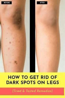 #ColdSoreRemediesThatWork Leg Scars, Dark Spots On Legs, Spots On Legs, Dark Spots On Face, Smooth Legs, Dark Spots On Skin, Skin Spots, Spots On Face, Beauty Tips For Glowing Skin