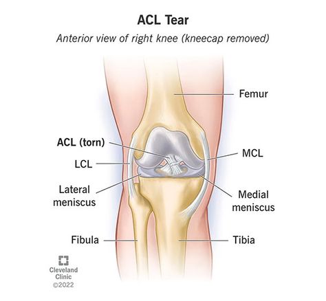 The ACL is the most commonly injured knee ligament. Sports injuries usually cause ACL tears. If you tear your ACL, you’ll probably need surgery to repair it. Most people who tear their ACL make a full recovery and resume playing sports with no long-term consequences. The recovery time for a torn ACL is usually six to nine months. Acl Tear Symptoms, Acl Knee, Acl Recovery, Acl Injury, Torn Acl, Knee Ligaments, Medical Illustrations, Acl Surgery, Anterior Cruciate Ligament