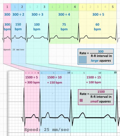 ECG Rate Interpretation • LITFL Medical Blog • ECG Library Basics Ekg Interpretation, Ecg Interpretation, Medical Assistant Student, Paramedic School, Medical Drawings, Nursing Classes, Med Surg Nursing, Nursing Assessment, Nursing School Essential