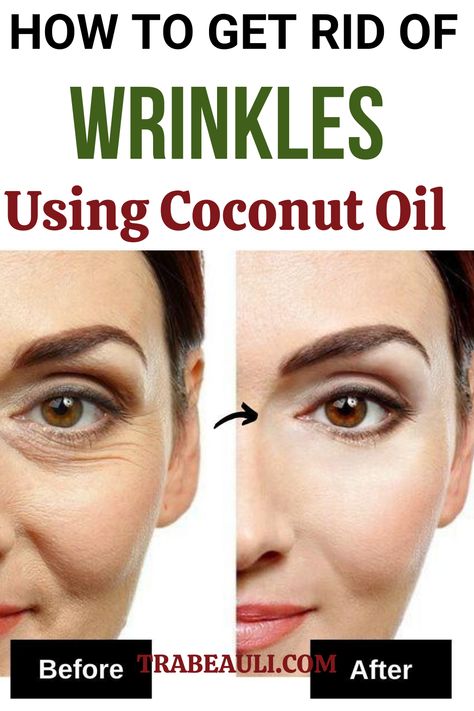 get rid of wrinkles Wrinkles Remedies Face, Home Remedies For Wrinkles, Diy Wrinkles, Get Rid Of Wrinkles, Wrinkle Remedies, Wrinkle Free Skin, Under Eye Wrinkles, Skin Care Wrinkles, Face Wrinkles