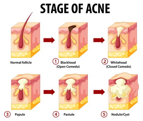 Everyone familiar with the problem of scalp acne, pimples, and sores knows firsthand how unpleasant and annoying the condition is. When you get acne on your scalp, you can’t fend off that horrible itching, which makes you nervous and irritated all the time. All your thoughts are about the pimples on the scalp that are … Pimples On Scalp, Painful Pimple, Scalp Acne, Back Acne Remedies, Blind Pimple, Pimples Under The Skin, Pimples Overnight, How To Get Rid Of Pimples, Acne Causes