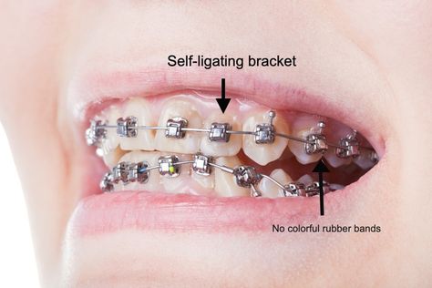 Self Ligating Braces, Natural Smile, Traditional Braces, Teeth Straightening, Teeth Braces, Dental Crowns, Healthy Teeth, Silver Spring, Dental Health