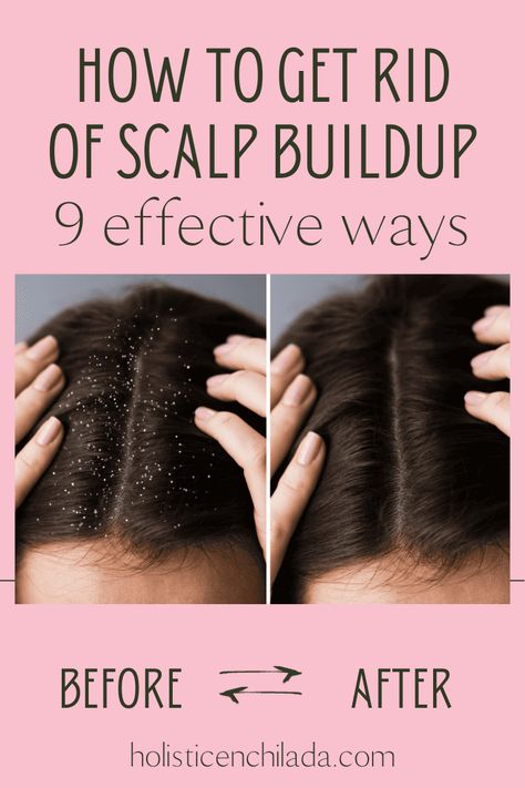 Wondering how to get rid of scalp buildup? Explore these 9 highly effective ways to achieve a cleaner, flake-free scalp with these expert-recommended strategies. How To Get Rid Of Flakes In Hair, Remove Buildup From Scalp, How To Deep Clean Your Scalp, How To Get Rid Of Product Build Up, What Helps With Dry Scalp, Healthy Scalp Remedies, Flakey Scalp How To Get Rid Of, Remove Scalp Buildup Diy, Sebum Buildup On Scalp