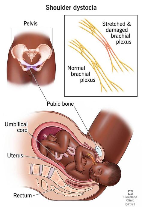 Shoulder Dystocia: Signs, Causes, Prevention & Complications Shoulder Dystocia Maneuvers, Midwifery Notes, Shoulder Dystocia, Obstetrics Nursing, Midwifery Student, Doula Training, Birth Education, Nurse Study Notes, Nurse Midwife