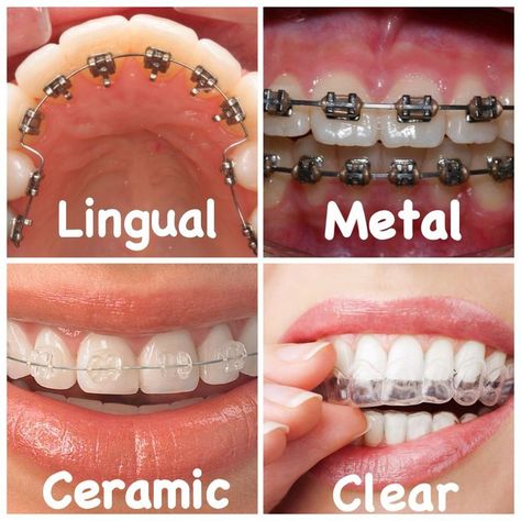 Lingual Braces, Natural Teeth Whitening Diy, Ceramic Braces, Types Of Braces, Braces Tips, Getting Braces, Clear Braces, Partial Dentures, Teeth Whitening Diy