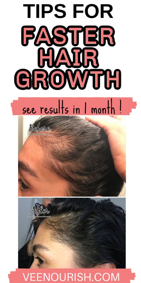 Hair Regrowth Grow Baby Hair, Hair Regrowth Remedies, Postpartum Tips, Hair Regrowth Women, Postpartum Hair, Faster Hair Growth, Get Thicker Hair, Overnight Hairstyles, Hair Growth Secrets