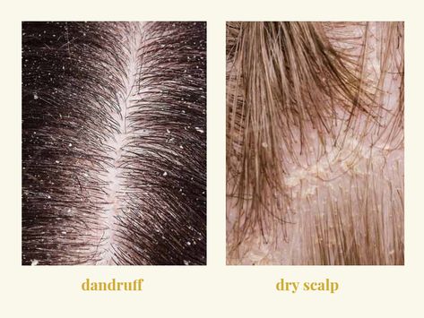 Dandruff vs. Dry Scalp: Causes, Symptoms, and Best Treatments Dry Scalp Vs Dandruff, Dandruff Flakes, Scalp Problems, Getting Rid Of Dandruff, Flaky Scalp, Scalp Oil, Oily Scalp, Dandruff Shampoo, Fast Hairstyles