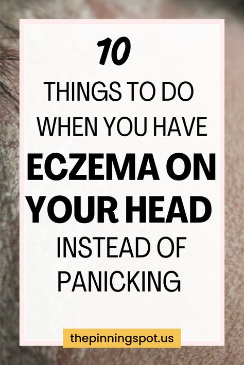 Looking for a solution to calm your itchy, flaky scalp? Explore our comprehensive guide to treating scalp eczema naturally. You'll learn expert advice on managing eczema flare-ups on your scalp. So if you're looking for eczema treatments for your scalp, we’ve gathered the best dry scalp remedies to help you find relief from eczema-related discomfort, combat flakiness, irritation and restore your scalp's health. Scalp Excema, Scalp Psorasischic Remedies, Dry Flaky Scalp Remedy, Seborrheic Dermitis On Scalp, Dry Scalp Remedies, Itchy Scalp Remedy, Scalp Remedies, Dry Scalp Remedy, Itchy Flaky Scalp