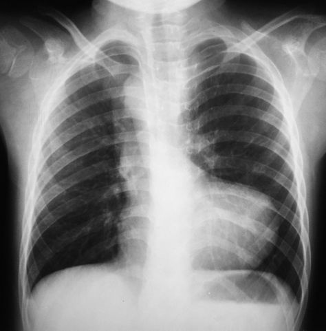 Tetralogy of Fallot | Radiology Case | Radiopaedia.org Brain Surgeon, Diagnostic Imaging, Icd 10, Chest Pain, Radiology, X Ray, Free Photos, Home Remedies, Instagram