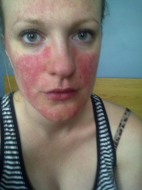 What is rosacea? Many people with rosacea don't know they have this skin condition so I have written about common symptoms and triggers. Read it here! Skin Care Home Remedies, Anti Aging Eye Cream, Anti Aging Face Cream, Natural Anti Aging, Skin Condition, Clear Complexion, Natural Moisturizer, Best Anti Aging, Anti Aging Skin Products