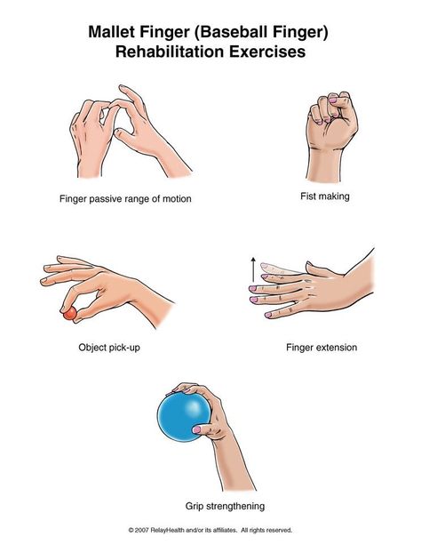 Hand Therapy Exercises, Mallet Finger, Remedial Massage, Rehabilitation Exercises, Finger Exercises, Physical Rehabilitation, Physical Therapy Exercises, Hand Exercises, Hand Therapy