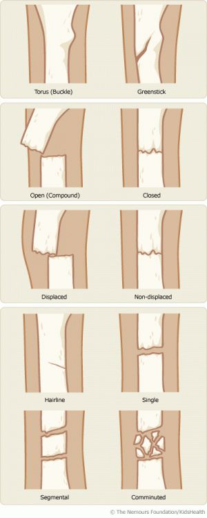 Fracture Types Types Of Fractures, Muzică Rock, Studera Motivation, Pa School, Nursing Life, Nursing School Studying, Nursing School Tips, Nursing School Notes, Medical School Studying