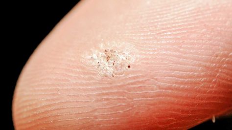 Seed Warts: Contagious, On Fingers, Home Remedies, On Foot Seed Wart, Planters Wart, Hugs Quotes, Wart On Finger, Flat Warts, Home Remedies For Warts, Warts Remedy, Natural Remedies For Migraines, Diy Mudroom