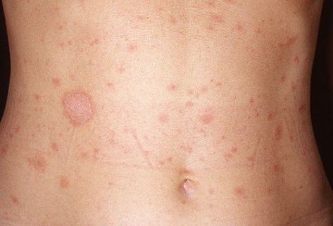 Body Rash, Types Of Rashes, Antifungal Cream, Itching Skin, Vitamins For Skin, Skin Disorders, Itchy Skin, Free Tips, Medical Prescription