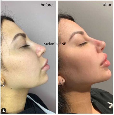 How to Use Chin Fillers to give Angulairity and a better Jawline to a Round Face - My Beauty Consultant Perfect Chin Shape, V Chin Aesthetic, Lip Filler Round Lips, Round Lip Filler, Chin Fillers Before After Round Face, Face Balancing Fillers, Round Lips Filler, Face Contouring Fillers, Cheekbone Filler Before And After