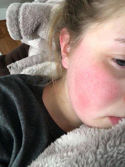 girl with bright red cheeks Sleeping Issues, Types Of Strokes, Red Cheeks, Too Much Estrogen, Musculoskeletal Pain, Estrogen Dominance, Healing Waters, Sleep Issues, Body Pain