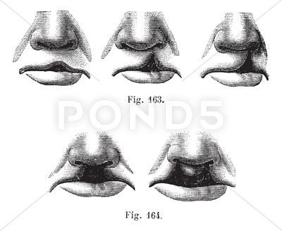 Fig. 163. Degrees of cleft lip simple, Fig. 164. Cleft lip double, vintage e Stock Illustration #AD ,#cleft#lip#simple#Fig Plump Lips Drawing Reference, Puckered Lips Drawing Reference, Cleft Lip Reference, Cleft Lip Drawing, Parted Lips Drawing, Over Drawn Lips, Lips Illustration, Engraved Illustration, Fnaf Au