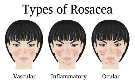 Rosacea is a chronic skin condition that presents as redness or flushing on the face, predominantly on the nose and cheeks. In more severe cases symptoms can range from rough or bumpy skin texture, swollen facial features, and even eye problems. About five percent of the population of the United States have rosacea. Rosy Skin, Lemongrass Spa, Apple Stem, Facial Treatments, Minimize Wrinkles, Bumpy Skin, Aging Face, Anti Aging Face Cream, Skin Redness