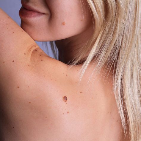 Woman with birthmarks on her back and face Cancerous Moles, Skin Tags On Face, Seborrheic Keratosis, Remove Skin Tags Naturally, Skin Moles, Mole Removal, Dark Underarms, Skin Issues, Dermatology