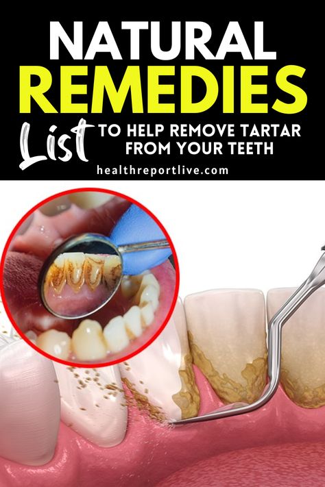 Natural Remedies List to Help Remove Tartar from your Teeth Get Rid Of Tartar On Teeth, How To Remove Plaque From Teeth, How To Get Plaque Off Teeth, Brushing Teeth With Baking Soda, Tartar Build Up On Teeth, Get Rid Of Plaque On Teeth, Stained Teeth How To Get Rid Of, How To Get Rid Of Tartar On Teeth, How To Remove Plaque From Teeth At Home