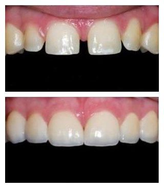 Veneers Teeth Cost, Gaps In Teeth, Gap Between Teeth, Teeth Veneers, Braces Cost, Veneers Teeth, Medical Animation, Discolored Teeth, Gap Teeth