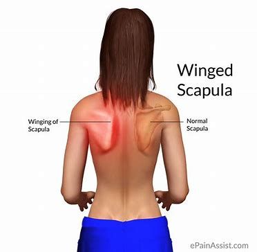 Winged Scapula Exercises, Scapular Winging, Scapula Exercises, Winged Scapula, Posture Fix, Shoulder Exercises, Tight Hip Flexors, Posture Exercises, Psoas Muscle