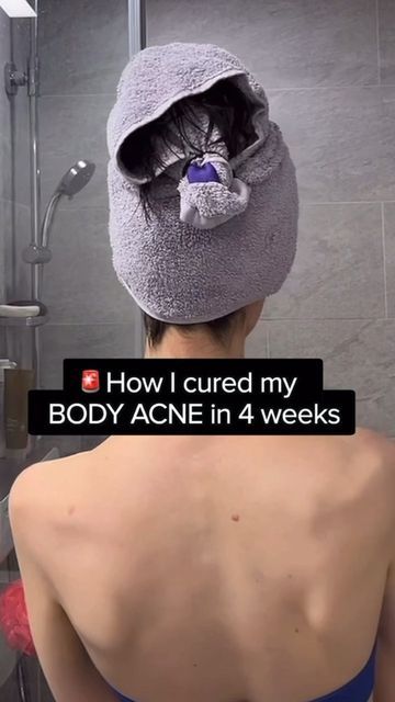 How To Get Rid Of Body Acne Fast, Nose Acne Cause, How To Treat Body Acne, Products For Back Acne, How To Clear Chest Acne, Backne Skin Care, Body Acne Routine, How To Treat Back Acne, Backne Remedies Fast