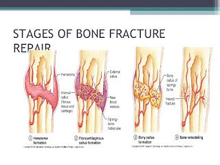 Ortho Neuro disorders: FRACTURE HEALING  Like healing of soft tissue woun... Fracture Healing, Vet Tech Student, Bone Fracture, Pdf Books Download, Med School, Medical Knowledge, Vet Tech, Survival Tips, Nursing School