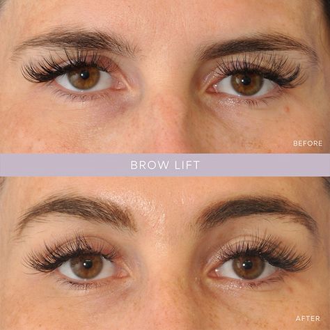 Endoscopic Brow Lift Before And After, Temporal Brow Lift, Brow Lift Botox Eyebrows, Brow Lift Before And After, Botox Brow Lift Before And After, Botox Eyebrow Lift, Thick Eyebrow Shapes, Eye Lift Surgery, Endoscopic Brow Lift