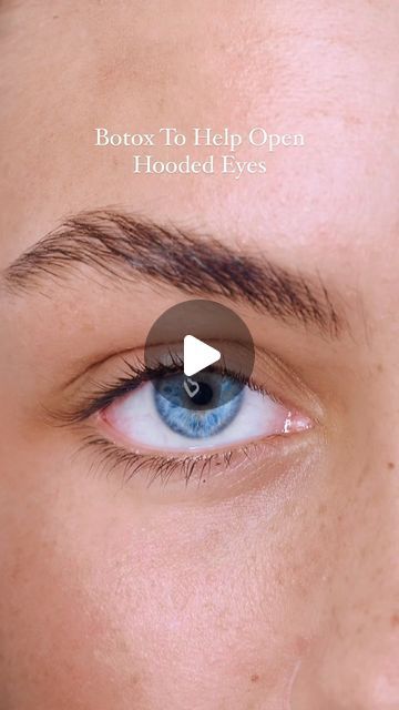 The Innovative MedSpa on Instagram: "Struggling with hooded eyes? You’re not alone! But don’t worry, there are solutions to help brighten and open up your eyes!

A Botox brow lift is a non-surgical way to relax those muscles that pull your eyebrows down, giving you a subtle lift and creating more space between your brow and lash line. ✨ 

This can make your eyes look bigger and more awake – perfect for anyone who wants a refreshed look!

Of course, every face is different, so it’s important to chat with a qualified professional to see if a Botox brow lift is right for you. 

But hey, if you’re curious about ditching the hooded eye struggle, this might be your answer! 

#hooded eyes #botoxbrowlift #openyoureyes #nonsurgical #refreshedlook #beautytips #417botox #417injector" Brow Lift Botox Eyebrows, Botox Brow Lift, Make Your Eyes Look Bigger, Brow And Lash, Eyes Look Bigger, Brow Lift, Hooded Eyes, Open Your Eyes, Med Spa