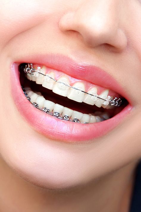 Ceramic braces are made of translucent (clear) material. They are most popular with adult patients, due to their cosmetic appeal. The main drawback to ceramic brackets is that they can be more fragile than traditional metal brackets. Orthodontics Photography, Perfect Teeth Braces, Teeth Study, Dental Orthodontics, Ceramic Braces, Types Of Braces, Adult Braces, Braces Tips, Traditional Braces